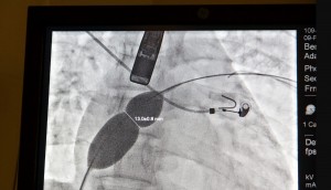 Új szívműtéti eljárás a zalaegerszegi kórházban
